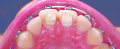 Bite bumpers 2.png