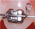 Long metal ligatures with Kobayashi (Kobi) hooks 2.png